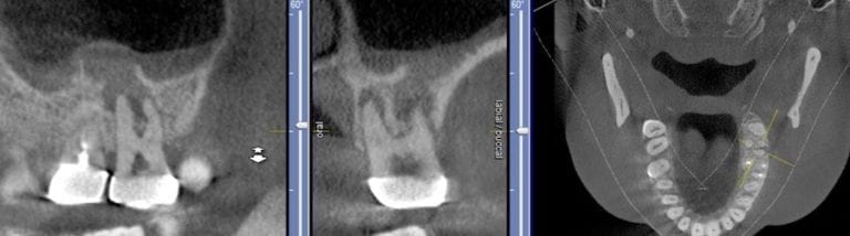 The path of least resistance in the maxilla is the floor of the sinus