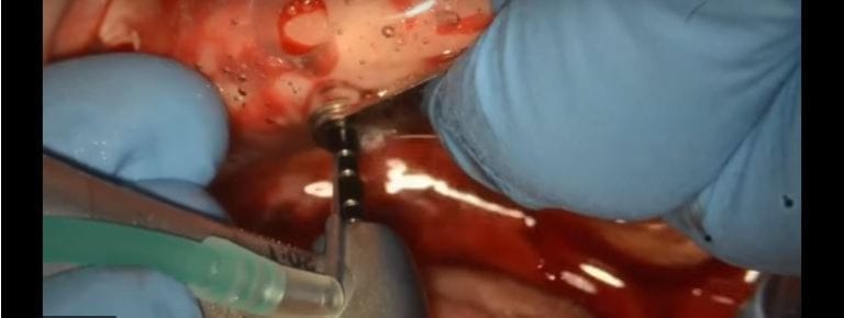 Introduction to Guided Surgery