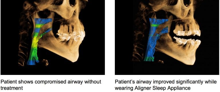 Measuring airway with a CT before and after appliance therapy is very misleading and dangerous