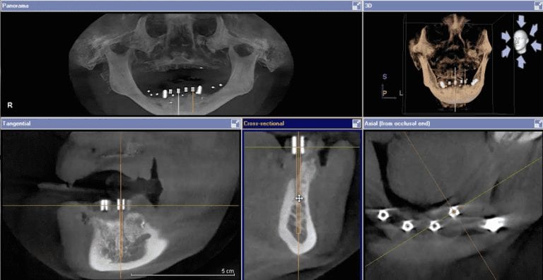 Check your surgical stent for accuracy before you do the surgery