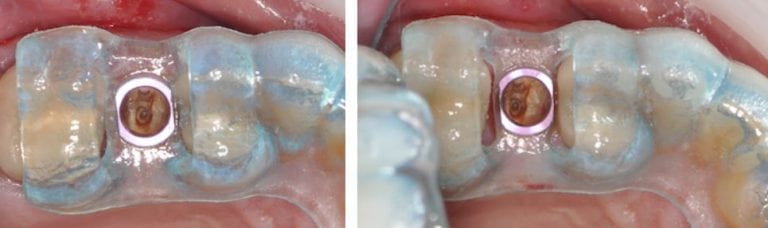 Common Clinical Issues with Guided Surgery