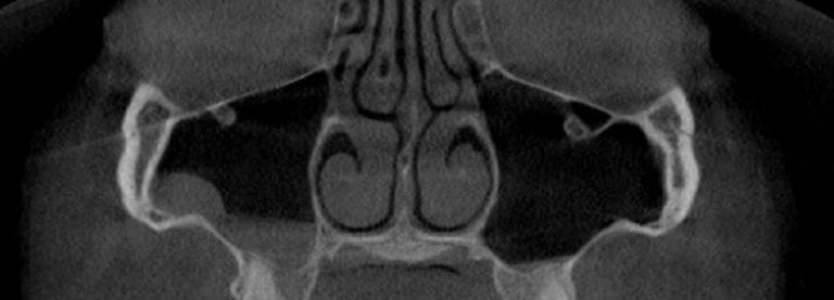 Enlarged Turbinates- easy to pick up on a large field CT