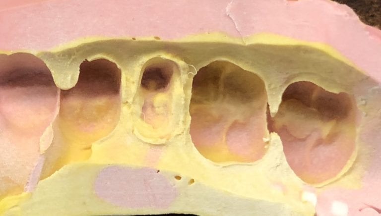 Premolar Crown Restoration from a Triple Tray and a Desktop Scanner