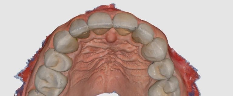 Scanning soft tissue, the palate, and emax with the Medit i500