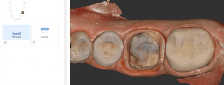 First Molar Crown Scan with Medit i500 with Opposing and Buccal Bite