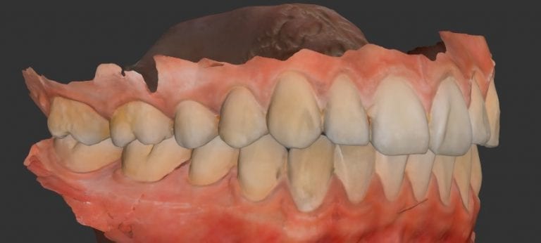 Full Arch Scan and Some Editing Tools in the Medit i500 Intraoral Scanner