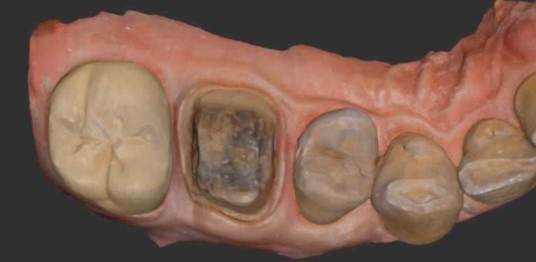 Upper and Lower First Molar Case Digitally Scanned with Medit i500