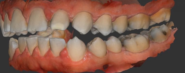 Occlusal Guard with Digital Impressions by Medit i500