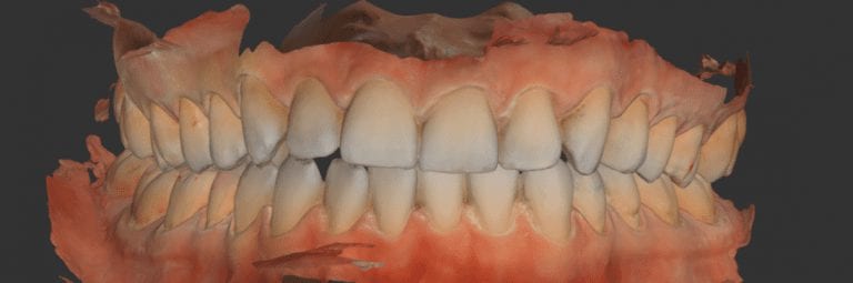 Full Arch Scans and Clear Aligners from Medit i500 Scans
