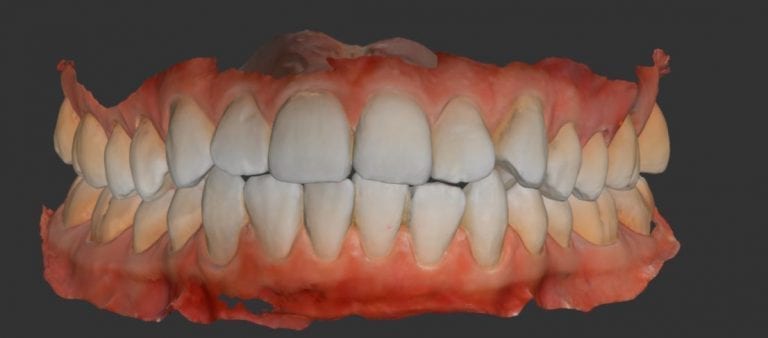 Checking Occlusion with Digital and Clinical Landmarks for a Clear Aligner Case