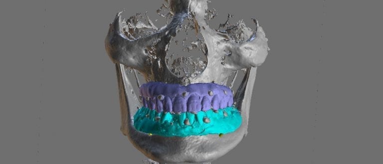 Denture Duplication with the Medit i500 for Guided Implant Planning and Surgery