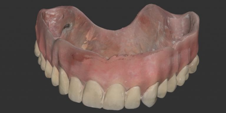 Duplicating an Existing Denture with Medit i500 Intra-Oral Scanner