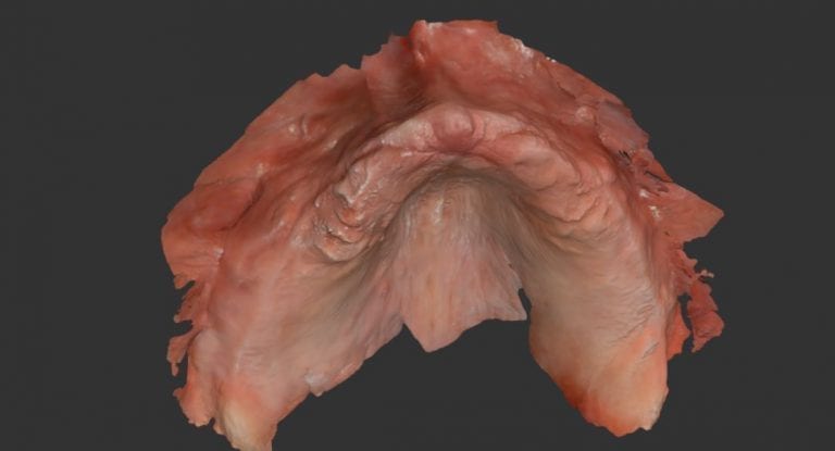 Yes, It Can Scan Edentulous Arches