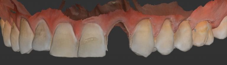 Virtual Extraction for Implant Planning