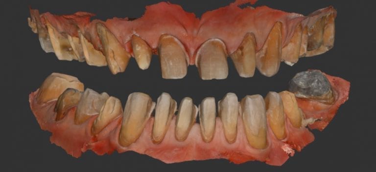 Full Mouth Reconstruction with Medit i500