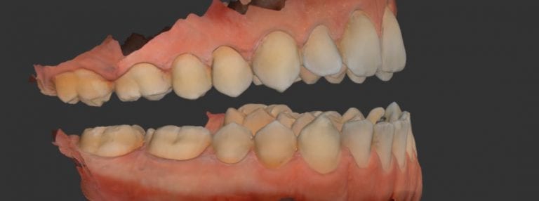 Digital Impressions for Obstructive Sleep Apnea Appliance
