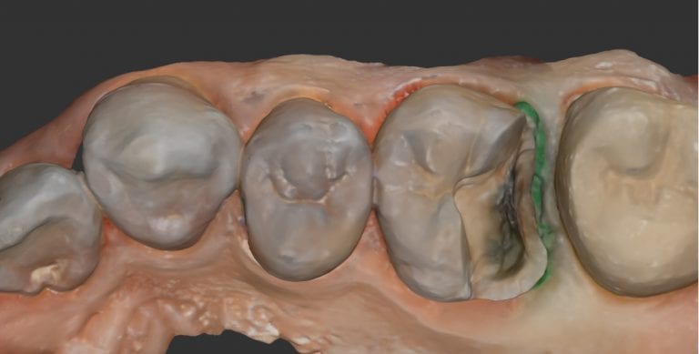 Onlay Restoration Imaged with the Medit i500 Intra-Oral Scanner