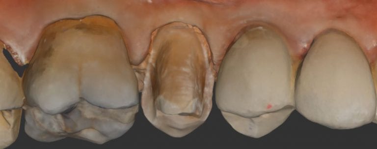 Premolar Onlay Captured in High Resolution Mode