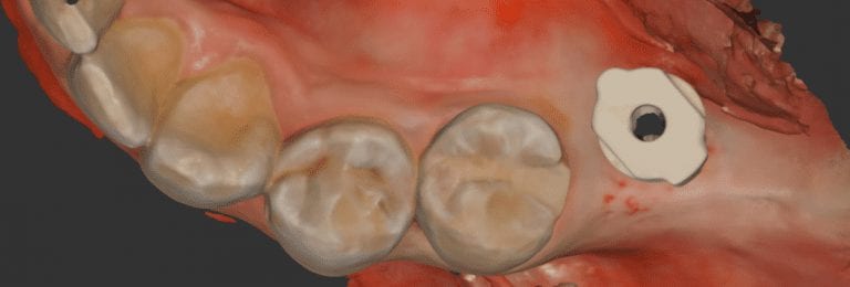 Digital Impression of a Scanbody for a Dental Implant