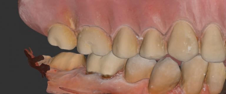Second Molar Emax with Medit i500