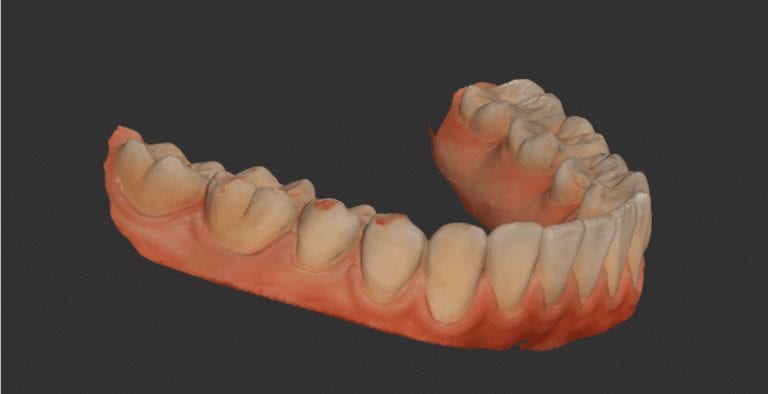 Full Arch Scan and Clear Orthodontic Retainer for Minor Tooth Movement