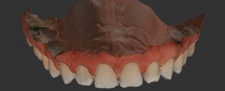 Clinical Reasons to use Digital Impressions