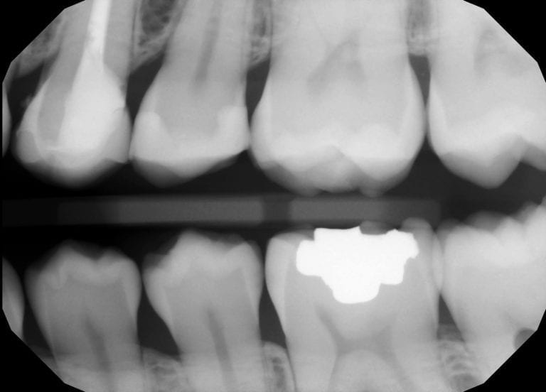 Margins by Medit and exocad by a CAD-Ray user