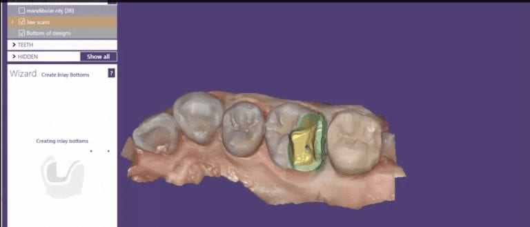 exocad DentalCAD Softare