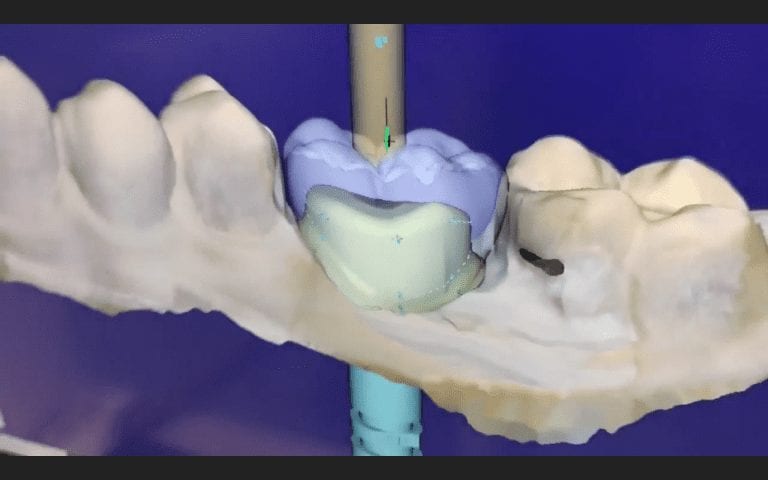 exocad Implant Design Module