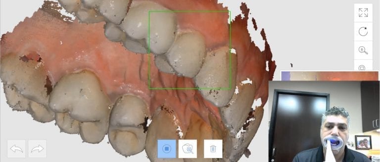 Fundamentals of Intra-Oral Scanners