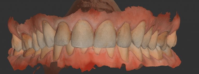 Smile Design and Makeover with Medit i500 and exocad