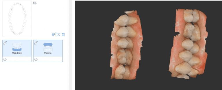 Transferring Buccal Bite Records in Medit i500
