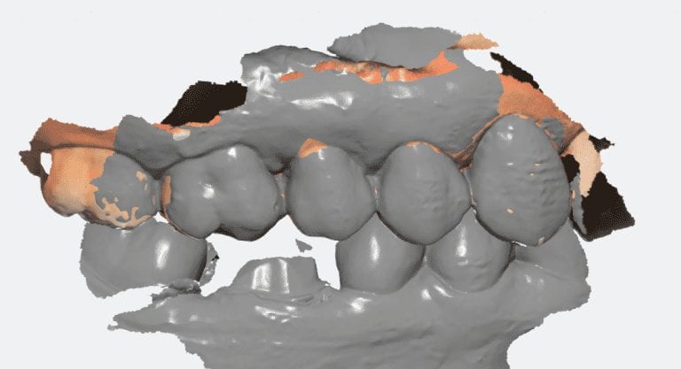A Common Issue with Buccal Bite Imaging