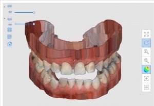 hollow model bases created by Medit i500 Intra-Oral Scanner for immediate printing