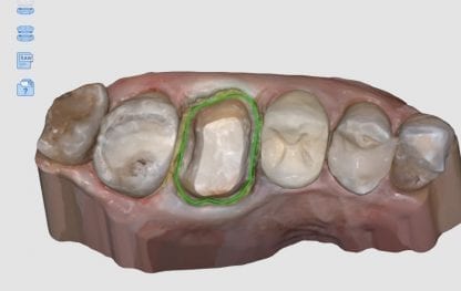 Medit i500 intra-oral scanner now comes with native margin marking feature