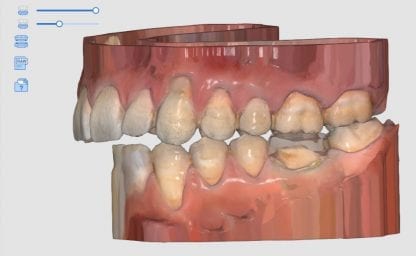 Medit i500 dental intra-oral scanner can now incorporate the pre-operative scan, the bite, the opposing and the prep model