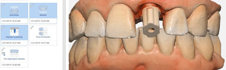 Mixing the Pre-Operative Condition, Mirroring the Neighboring Tooth, and Using a Scan-Body to Restore a Left Central Incisor with Medit i500 V2.0