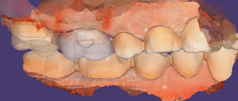 Three Ways to Tackle Adjacent Crowns