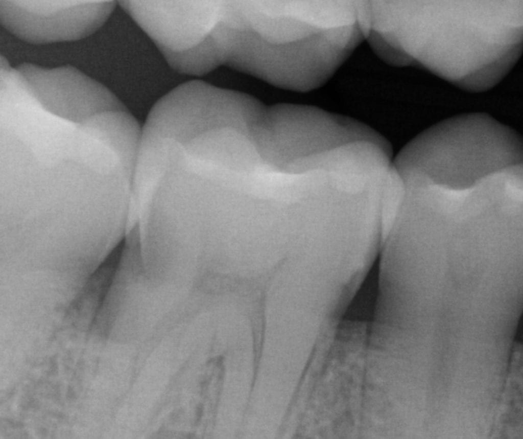 zirconia crown