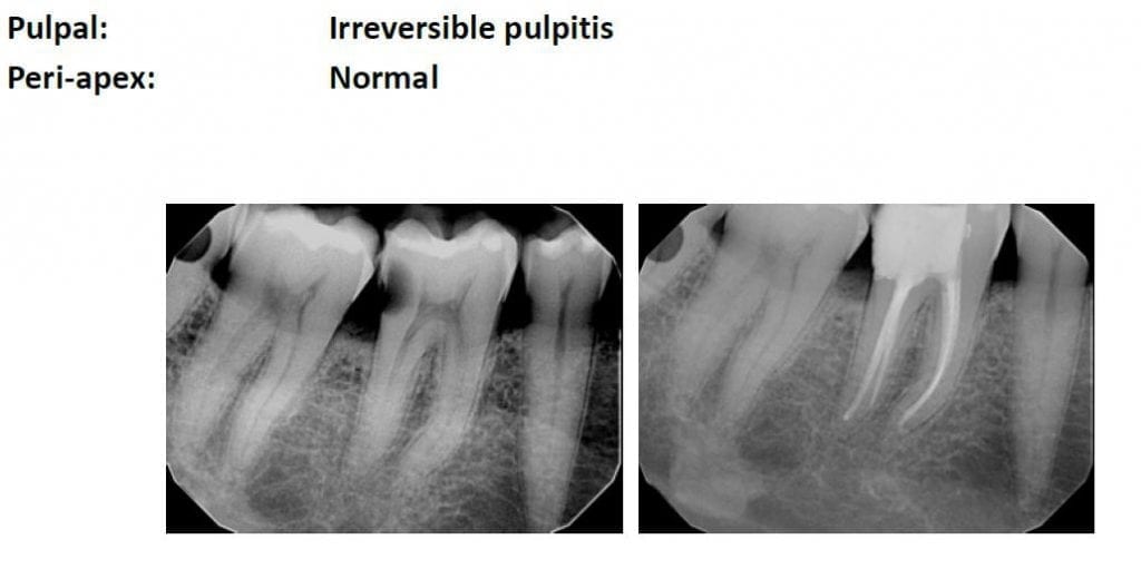 zirconia crown by medit i500 after rootcanal