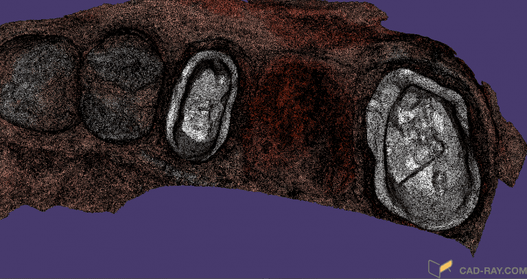 Bridge Replacement with the Medit i500 Using Copy Mode of the Pre-op, White Light for Red Tissue, Blue Light for Tooth Structure, and Segmented Model Building