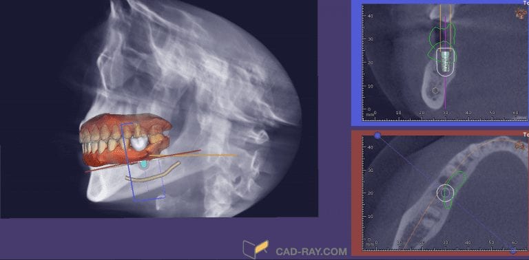 Implant Planning with Any CT Machine and Any Intra-Oral Scanner with CAD-Ray Software