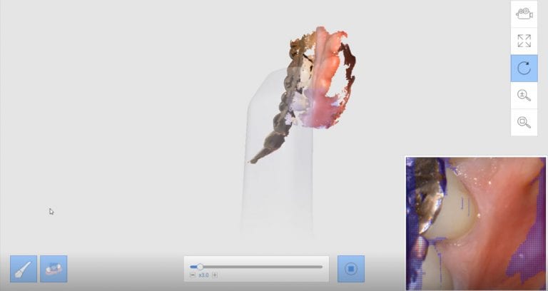 Imaging a Mouth Full of Gold and PFM Crowns