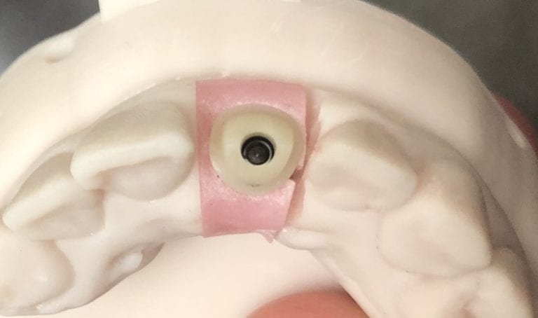 Milling Screw Access Hole and emax Abutment with Z4