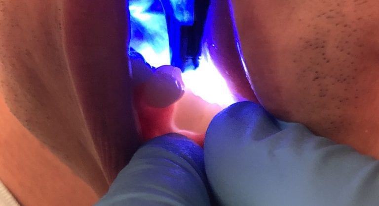 Cracked Tooth Treated with Medit i500 and emax Milled With Z4 by VHF