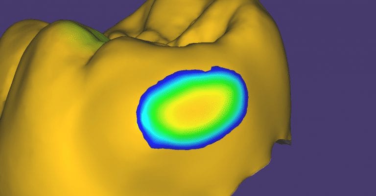 An Important Lesson About Contact Area Design With Digital Impressions