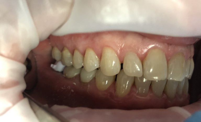 Managing a Second Molar with Medit i500 and exocad design software
