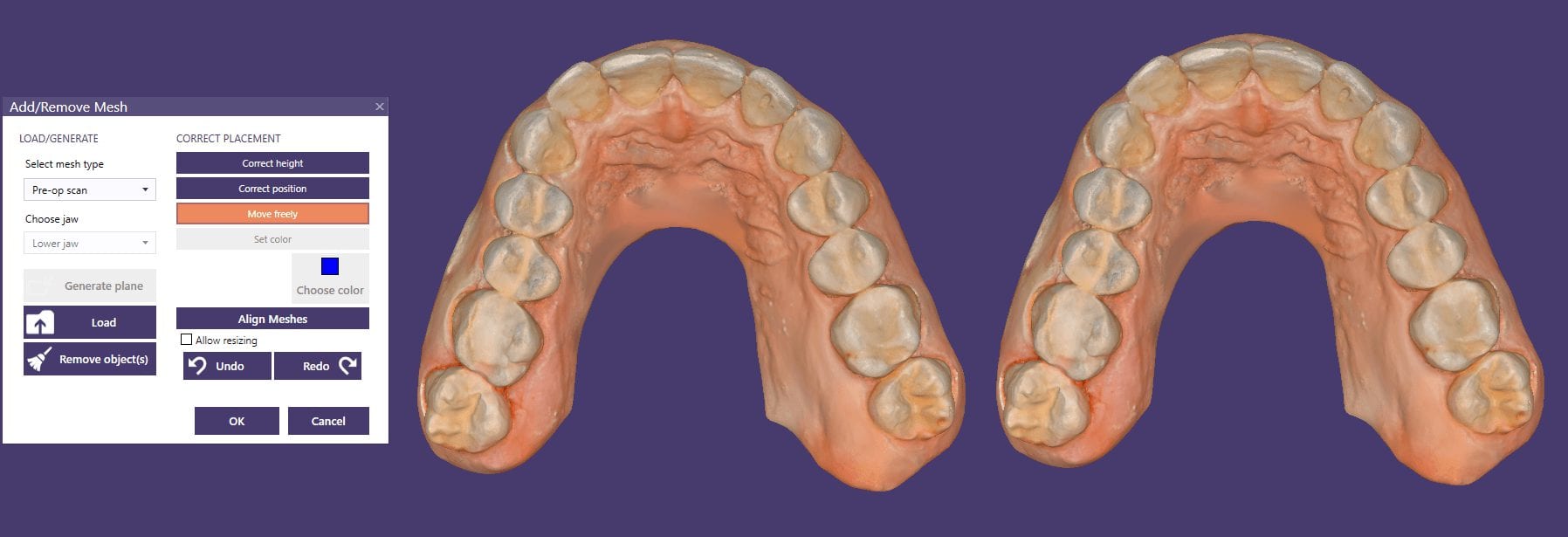 digital dental design