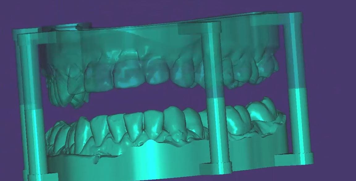 Optimizing a 3d scan for oral appliance fabrication using support pins before sending the image to the lab