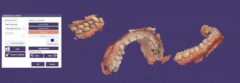Bite Alignment Scan to the Rescue in exocad